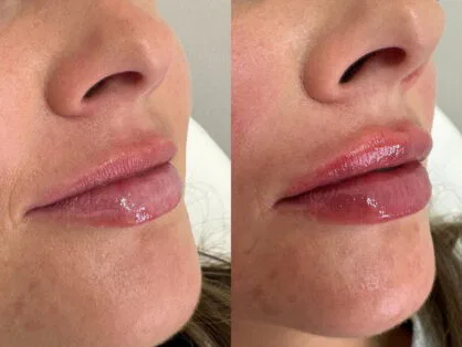 Close-up side-by-side images of a persons face, focusing on the lips and lower nose area. The left image shows natural lips, while the right image showcases slightly enhanced lips with a glossy finish. The skin tone is fair, and the lighting is soft.