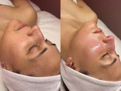 A side-by-side comparison of a person receiving a facial treatment. The left image shows the face before treatment, and the right shows a smoother, more radiant complexion. The person wears a white headband, and their eyes are closed.