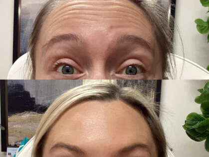 A woman is shown before and after a procedure